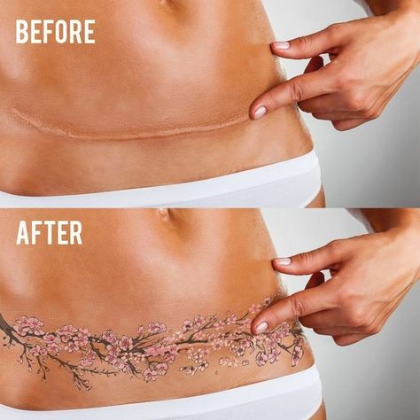 Use Tattoo To Cover Stretch Marks #1 — Steemit Tummy Scar Tattoo, Tattoos For Scars Cover Up, Tattoo Covering Scars, Scar Tattoo Cover Up, Tattoo For Scars, Tattoo To Cover Scars, Tattoo Scar Cover, Scar Cover Up Tattoo, Scar Cover Tattoo