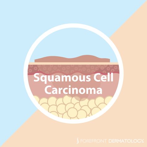 Squamous Carcinoma, Tanning Beds, Skin Facts, Type Of Skin, Squamous Cell, Tanning Bed, Lymph Nodes, Sun Exposure, Med School