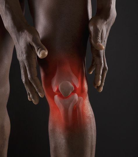 Inflammation is characterized by five cardinal signs: redness, heat, swelling, pain, and loss of function. Learn more about the signs and symptoms. Bursitis Knee, Knee Strengthening Exercises, How To Strengthen Knees, Knee Exercises, Knee Pain Relief, Joints Pain Relief, Strengthening Exercises, Chronic Inflammation, Muscle Fitness