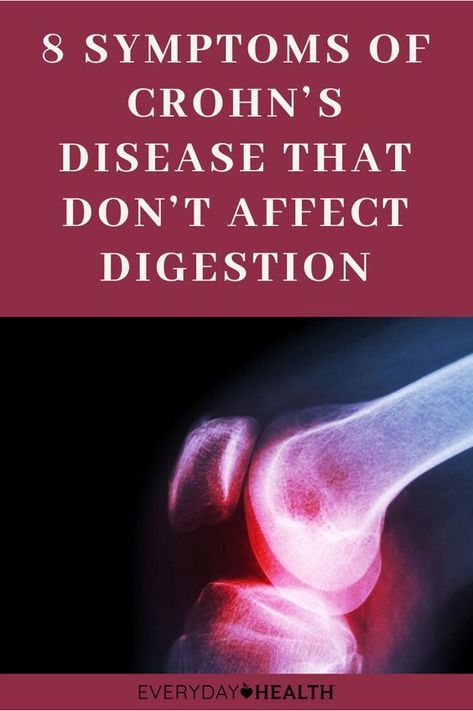 Chrons Disease Symptoms, Crohns Friendly Recipes, Crohns Symptoms, Chrons Disease, Crohns Awareness, Digestive Tract, Disease Symptoms, Oral Health Care, Chronic Inflammation