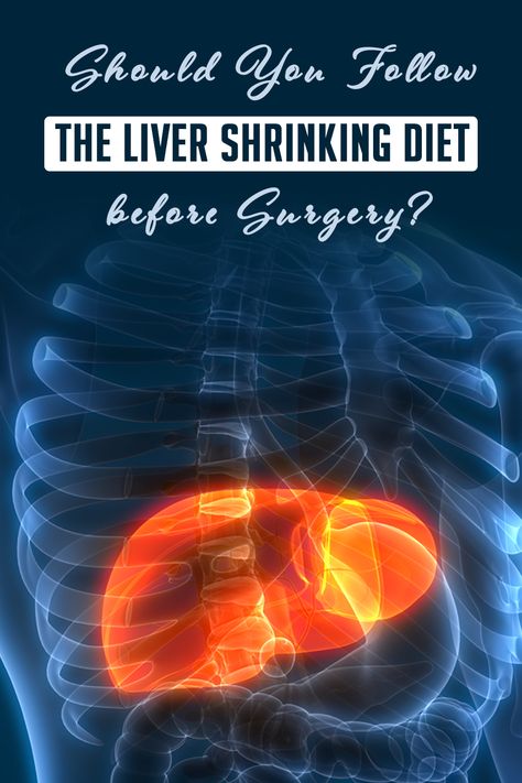 What is the Liver Shrinking Diet and what are the benefits of following it prior to WLS? Learn all about this targeted diet from @drsusanmitchell and how shrinking your liver helps promote a better surgical outcome and long-term journey. #wls #bariatricsurgery #weightlosssurgery #rny #gastricbypass #vsg #verticalsleeve #ds #duodenalswitch #lapband #weightlosstips #weightloss #weightlosshelp #obesityhelp #wlscommunity #wlsjourney Liver Reduction Diet, Liver Shrinking Diet Meal Plan, Bariatric Liver Shrinking Diet, Liver Shrinking Diet, Sluggish Liver, Cirhossis Of The Liver Diet, Obesity Help, Where Is The Liver Located, Reduction Diet