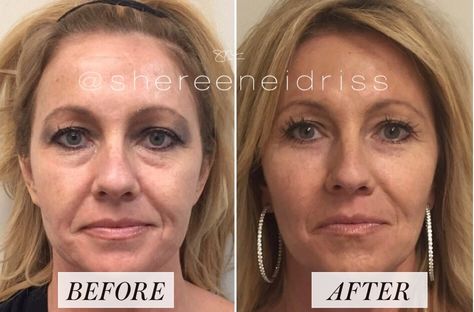 Everything You've Ever Wanted to Know About Fillers Cosmetic Injections, Chin Filler, Cosmetic Fillers, Under Eye Fillers, Botox Before And After, Face Fillers, Health Tricks, Tear Trough, Cheek Fillers