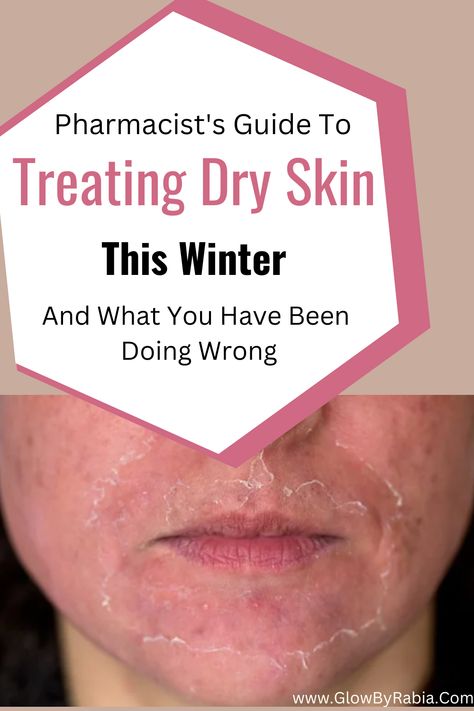 Very Dry Skin Face, Dry Flaky Skin On Face, Dry Skin Remedies For Face, Flaky Skin On Face, Dry Skin Products, Dry Skin In Winter, Remedies For Dry Mouth, Dry Scaly Skin, Oily Skin Remedy