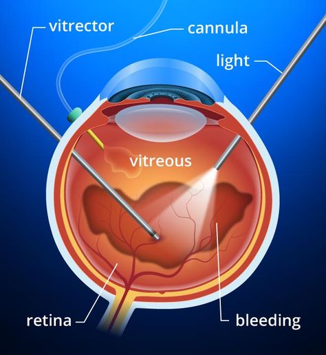 Vitrectomy Surgery, Eye Health Facts, Eye Diseases, Eye Facts, Eye Clinic, Eye Surgeon, Laser Surgery, Medical Anatomy, Eye Surgery