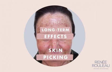 Picking At Your Skin Causes Damage And This Photo Proves It Stop Picking Face, Heal Skin After Picking, Stop Skin Picking, How To Stop Picking Your Face, How To Stop Skin Picking, How To Stop Picking Skin, Stop Picking Skin, Picking At Skin, Skin Picking