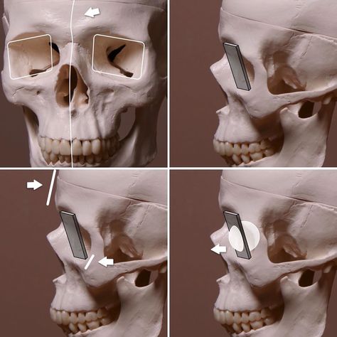 746 Likes, 1 Comments - Stephen Bauman (@stephenbaumanartwork) on Instagram: “Some of my illustrations from the eye structure tutorial I made. There’s a link to a free sample in…” Eye Socket Drawing, Stephen Bauman, Eye Sculpture, Drawing A Portrait, Planes Of The Face, Eye Structure, Human Anatomy Reference, Eye Socket, Skull Anatomy