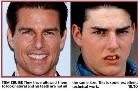 It looks like Tom Cruise has had some dental work done.  Most likely, the "Mission Impossible" star has some pearly white veneers. Tom Cruise Teeth, Celebrity Teeth, Celebrity Smiles, Laser Teeth Whitening, Fake Teeth, Perfect Teeth, Celebrities Before And After, Smile Makeover, Best Dentist