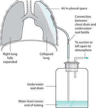 Chest tube with underwater seal Chest Tube Drainage System, Chest Tube, Child Nursing, Nursing Exam, Pulmonology, Fundamentals Of Nursing, Respiratory Therapy, Med Surg, Nursing Care