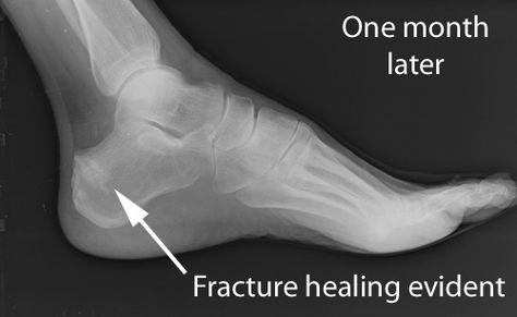 Fracture Healing, X Ray, Healing