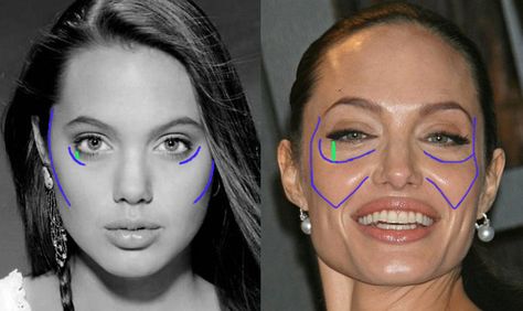 younger Angelina has shorter vertical height of the lower eyelid zone.  With aging, the cheeks change in shape & dimension consistent with the normal changes seen in facial bony remodeling. There are multiple changes occurring at three primary levels within the face ( the skin, the soft tissues, and the bone).   The skin surface takes on irregularities in both texture and pigment.  Fat and bone undergo atrophy (shrinking) and remodeling in specific targeted locations throughout the face Bony Face, Facial Aging, Aesthetic Dermatology, Facial Treatments, Facial Rejuvenation, Facial Muscles, Dermal Fillers, Beauty Equipment, Aging Well