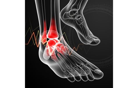 Top 5 Women Specific Running Injuries Ankle Replacement, Calf Injury, Ankle Surgery, Running Injuries, Ankle Injury, Sprained Ankle, Medical Illustration, Shoulder Pain, Just Run