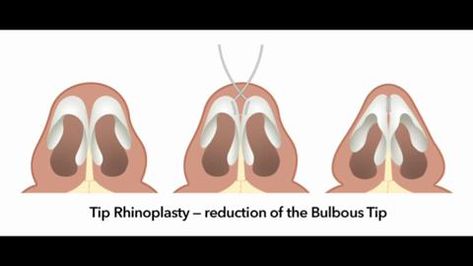 Rhinoplasty and Reduction of the Bulbous Tip Nose Reduction, Bulbous Nose Rhinoplasty, Bulbous Nose Rhinoplasty Before After, Nose Plastic Surgery, Bulbous Nose, Nose Reshaping, Rhinoplasty Before And After, Aesthetic Dermatology, Rhinoplasty Nose Jobs