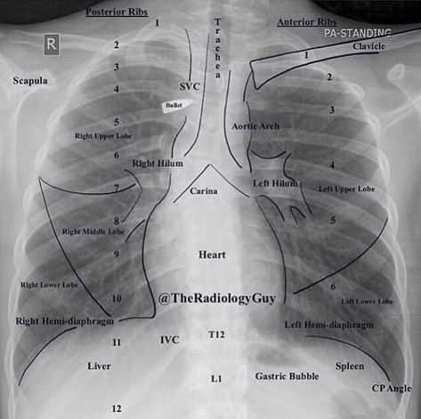 Chest Xray, Radiology Schools, Medical Radiography, Radiology Student, Radiology Imaging, Medicine Notes, Medical Student Study, Respiratory Therapy, Medical School Inspiration