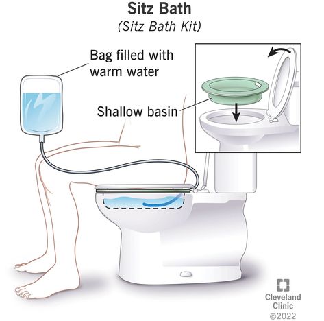 Sitz Bath: Definition & Benefits Bath Soak Recipe, Sitz Bath, Hemorrhoid Relief, Bath Kit, Tub Ideas, Shower Chair, Clean Towels, Cleveland Clinic, Muscle Spasms