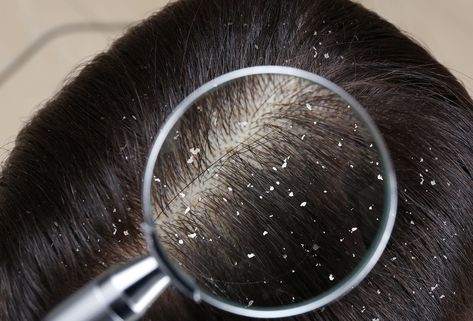 Dandruff and seborrheic dermatitis both seem to result from a reaction to yeast that normally live on the skin. You CAN control Malassezia! Natural Dandruff Remedy, Home Remedies For Dandruff, Dandruff Remedy, Scalp Problems, Oily Scalp, Scalp Health, Flaky Skin, Scalp Conditions, Mild Shampoo