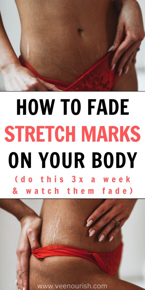 Stretch Marks Remedies | How To Remove Stretch Marks Fast & Naturally Stretch Mark Prevention, Stretch Mark Removal Cream, Strech Marks, Stretch Mark Remedies, How To Fade, Stretch Mark Removal, Stretch Mark Cream, Health Hacks, Stretch Mark