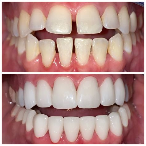 We Can Fix Your Teeth Without Braces - 2 visit Smile Makeover with Zirconia Crowns - Smile Again Dental - Dr Kenny Smiles - Call (972)696-9273 Call For Your Consultation #dentistry #dentistrymyworld #beforeandafter #cosmeticdentistry #veneers #zirconia #zirconiacrowns #dental #smilemakeover Zirconia Crowns Teeth, Teeth Makeover, Ceramic Braces, Cosmetic Dentistry Procedures, Veneers Teeth, Teeth Whitening System, Dental Cavities, Diy Teething, Grills Teeth