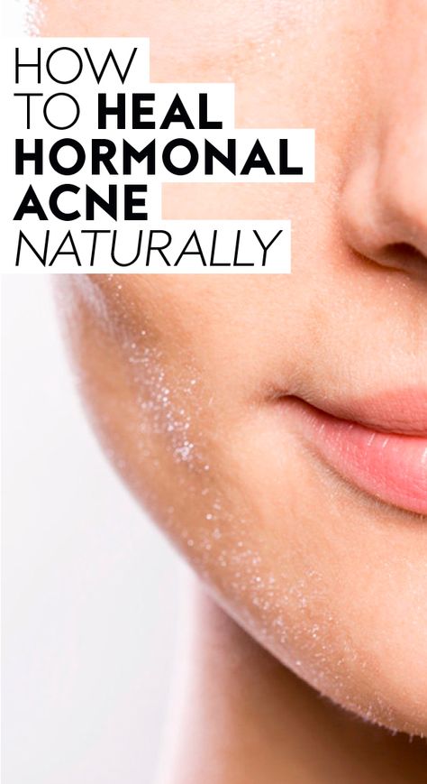 How to Heal Hormonal Acne Naturally | Stubborn hormonal cystic acne or jawline breakouts can be a huge bummer. Read more about underlying acne causes, natural remedies, and home treatments so you can find a skincare routine that boosts your confidence and leaves you with glowing, healthy skin.   #womenshealth #healthtips #healthy #tipsforwomen #personalcare #skincaretips #skincare Neck Acne Causes, Hormonal Cystic Acne, Jawline Acne, Neck Acne, Treating Cystic Acne, Hormonal Acne Remedies, Chin Acne, Back Acne Remedies, Forehead Acne