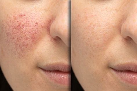 If your skin is plagued by acne or rosacea breakouts, visit Pharmacy Planet to buy treatments like Skinoren, Lymecycline, and Rozex Gel and Cream online in the UK Skin Needling, Plant Based Skincare, Improve Skin Tone, Skin Care Treatments, Youthful Skin, Skin Concern, Skin Tightening, Skin Rejuvenation, Improve Skin