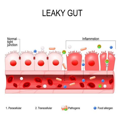 Leaky Gut, Food Sensitivity & Autoimmune Disease Healthy Gut Diet, Gut Healing Diet, Yeast Overgrowth, Healing Diet, Heal Leaky Gut, Gut Healing Recipes, Gastrointestinal Disorders, Stomach Issues, Improve Gut Health