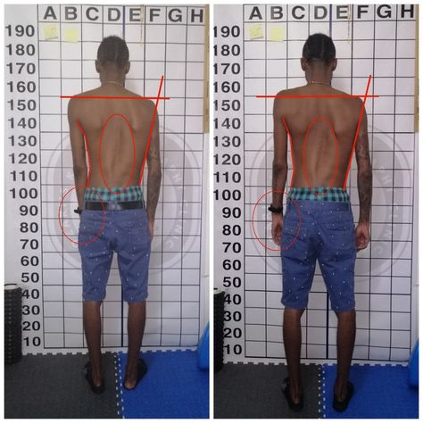 SCOLIOSIS EXERCISE PROGRAM   @ Ozari's Kinesiotherapy Clinic  GOALS OF EXERCISE PROGRAM   To reduce postural rotation and improve postural control of the muscles in the Trunk.   To improve muscular strength and postural stability of the Trunk.   To improve the mobility of any tight structures in the Truck.   To improve cardiopulmonary function.   To improve vital lung function.   To reduce pain.   WhatsApp: 17845337066 Muscular Strength, Exercise Program, Workout Programs, Back Pain, Muscles, Trunk, Tights