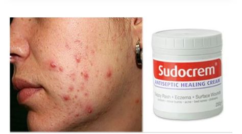 Sudocrem Acne, Rash Cream, Acne Scar, Get Rid Of Acne, Rid Of Acne, How To Get Rid Of Acne, Mind Body And Soul, Body And Soul, Care Tips