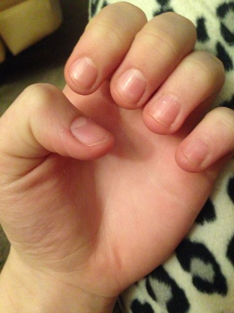 Day 1, the day I decided to stop biting my nails Bitten Nails, Nail Growth Faster, Nail Growth Tips, Food Nails, Nail Care Routine, Casual Nails, How To Grow Nails, Nutritious Diet, Nail Growth