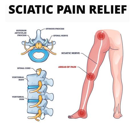 Immediate Relief from Sciatic Pain in 4 Minute! Sciatic Pain Relief, Sciatic Nerve Exercises, Nerve Pain Remedies, Sciatic Nerve Relief, Sciatic Nerve Pain Relief, Chronic Pain Management, Chronic Lower Back Pain, Sciatica Exercises, Sciatica Pain Relief