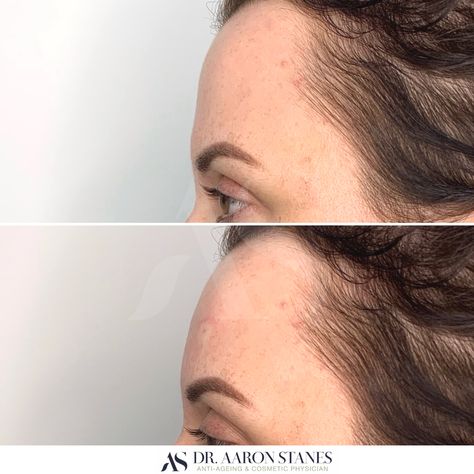 Forehead Filler Before And After, Flat Forehead Side Profile, Flat Face Side Profile, Flat Side Profile, Forehead Filler, Round Forehead, Perfect Forehead, Flat Forehead, Forehead Surgery