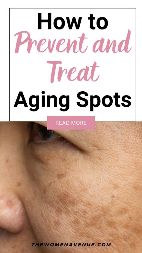 Are you suffering from aging spots on your face? Are you looking for ways to prevent more aging spots to appear? In this post I am sharing with you the BEST and natural ways you can treat them! Did you know that you can fade dark spots within a few weeks only?! Click Here to read how! How To Close Pores, Age Spots On Face, Age Spot Removal, Dry Oily Skin, Dark Spots On Face, Lower Back Pain Exercises, Skin Tags, Spots On Face, Clear Face