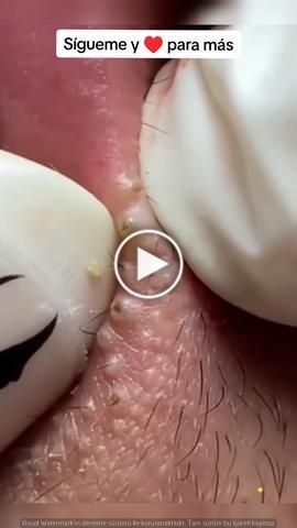 pimple popping / blackheads removal Pimples Around Lips, Big Blackheads Removal Satisfying Videos, Lip Blackheads, White Pimples On Face, Cystic Pimple Pop, Cysts Popping Videos, Acne Popping, Blackheads On Back, Neck Pimples