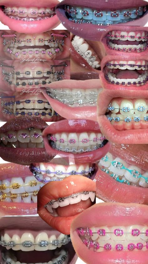 Gold Power Chain Braces, Braces Colors For Blondes With Blue Eyes, Nice Braces Colors, Dark Pink Braces, Periwinkle Braces, How To Make Fake Braces, Baddie With Braces, Light Pink Braces, Royal Blue Braces