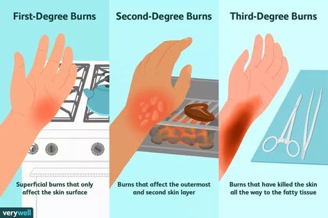 Types Of Burns, First Aid For Burns, 2nd Degree Burns, Burn Remedy, Chemical Burn, Degree Burns, Severe Burns, Skin Grafting, Skin Burns