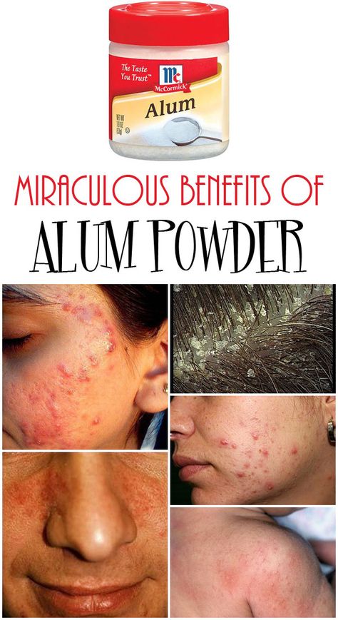 Alum Powder, Rid Of Dandruff, Chest Acne, Forehead Acne, Hair Removal Diy, Getting Rid Of Dandruff, Underarm Hair Removal, Remove Hair, Vicks Vaporub