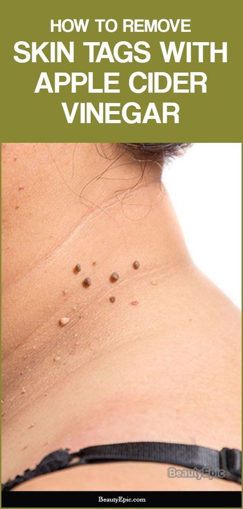 Mole Removal Apple Cider Vinegar, Diy Remove Skin Tags At Home, Remove Skin Tags Naturally Apple Cider, Essential Oils For Skin Tags Removal, Natural Ways To Get Rid Of Skin Tags, Essential Oil Skin Tags, Skin Tags Removal Overnight How To Get Rid, Apple Cider Vinegar For Skin Tags, Get Rid Of Skin Tags Fast