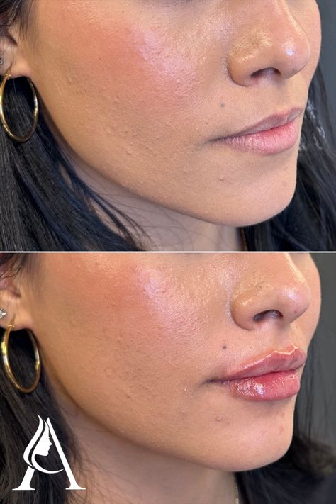 Lips before and after - we're OBSESSED with this first-time lip filler transformation!

Restylane Kysse lip filler in Philadelphia, PA. 

Book a consultation with our amazing injectors at Ari Blanc Medical Spa for your own lip makeover! Filler Transformation, 1ml Lip Filler, Dermal Fillers Lips, Lip Flip, Lips Inspiration, Botox Lips, Facial Fillers, Lip Augmentation, Small Lips