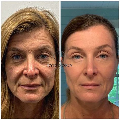 Full Face plasma fibroblast before and after Fibroblast Skin Tightening, Skin Transformation Before And After, Fibroblast Before And After, Lip Flip Fibroblast, Fibroblast Plasma Skin Tightening, Skin Branding, Plasma Fibroblast, Eyelash Extension Course, Bulbous Nose