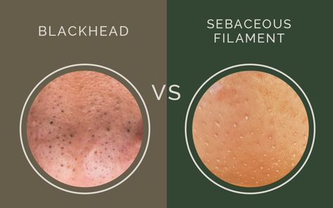 blackhead versus sebaceous filament, what's the difference? congestion / clogged pores / Clogged Pores On Nose, Blackheads On Cheeks, What Are Blackheads, Pores On Face, Sebaceous Filaments, Nose Pores, Blackheads On Nose, Rid Of Blackheads, Mole Removal