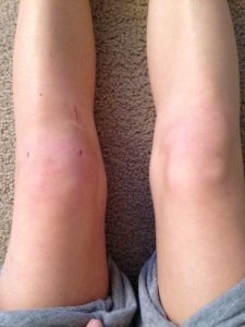 ACL Post-Surgery Week 4 - what to expect & recovery! Post Acl Surgery, Acl Surgery Recovery, Yoga For Knees, Knee Surgery Recovery, Acl Surgery, Knee Surgery, Surgery Recovery, Post Op, Post Surgery