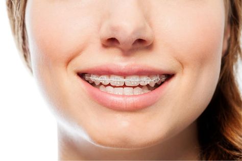 Braces Dentist, Ceramic Braces, Fix Teeth, Braces Cost, Adult Braces, Clear Braces, Dental Braces, Teeth Straightening, Teeth Braces