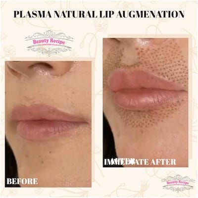 Lip Flip Fibroblast, Plasma Facial, Lift Contour, Plasma Fibroblast, Skin Mapping, Lip Flip, Skin Tightening Procedures, Medical Esthetician, Pouty Lips