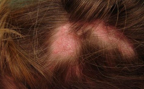 Lichen planopilaris is a rare inflammatory condition that results in patchy, progressive hair loss mainly on the scalp. Gain a deeper understanding of this medical condition by learning its causes and recommended treatments. #lichenplanopilaris #lichenplanopilarishairloss #hairloss #lichenplanopilaristreatments Lichen Planopilaris, Frontal Fibrosing Alopecia, Lichen Planus, Human Hair Pieces, Hair Toupee, Quiff Hairstyles, Combo Skin, Frontal Hairstyles, Hair System