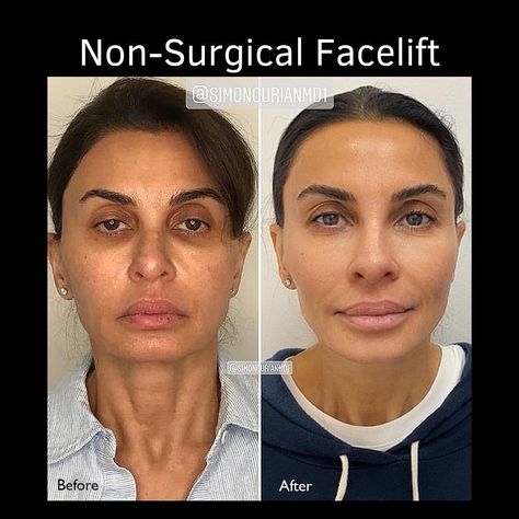 Using a combination of NEUSTEM™ injections, Ultrasound, and COOLASER® we are able to reverse signs of aging through the non-surgical facelift. Non Surgical Facelift, Ultrasound, Aging Signs, Signs, Quick Saves