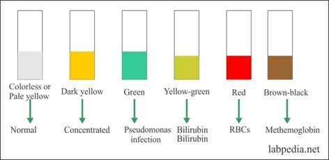 Urine Analysis – part 4 – Urine Analysis, Urine Physical characters, and Interpretation – Labpedia.net Urine Analysis, Medical Analysis, Skeleton System, Methylene Blue, Physical Examination, Acid Base Balance, Lymph Fluid, Squamous Cell, Fluid And Electrolytes