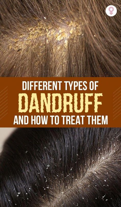 There are different types of dandruff. To effectively treat it and prevent future flakes, we Hair Mask For Dandruff, Oils For Dandruff, Dandruff Remedy, Getting Rid Of Dandruff, How To Grow Your Hair Faster, Natural Acne Remedies, Baking Soda Shampoo, Flexible Dieting, How To Grow Nails