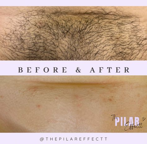 Real Clients, Real Results 🌸 Consistent exfoliation (3-5 times a week) is key to achieving flawless waxing results! Keep your skin smooth and healthy. ✨ Book your Brazilian wax appointment today! 💜 #Esthetician #WinterPark #ThePilarEffectt #WaxingStudio #BrazilianWaxing #WaxSpecialist #Sugaring #SmoothSkin — Let me know if you need any further adjustments! Brasilian Wax, Wax Appointment, Healthy Book, Brazilian Waxing, Marriage Goals, Real Results, Esthetician, Smooth Skin, Wax