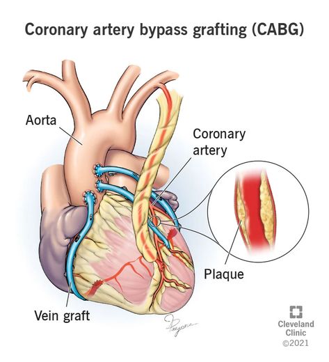 Coronary Bypass Surgery: Purpose, Procedure and Recovery Quadruple Bypass Heart Surgery, Coronary Bypass Surgery Heart, Ram And Krishna, Calcium Channel Blockers, Heart Doctor, Chest Discomfort, Vein Removal, Coronary Artery, Nclex Prep