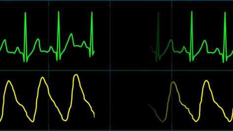 EKG Display Monitor on Behance Cardiac Monitor Tech, Hospital Heart Monitor, Ekg Arrythmias, Cardiac Dysrhythmias, Heartbeat Monitor, Heart Monitor, Red Background Images, Heart Rate Monitor, Heart Rate