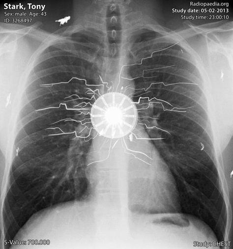 Chest x-ray of Tony Stark (aka Iron Man) | Radiology Case | Radiopaedia.org Medische Humor, Marvel Tony Stark, Toni Stark, Marvel Aesthetic, Marvel Wall, Marvel Iron Man, Marvel 3, Robert Downey, Radiology