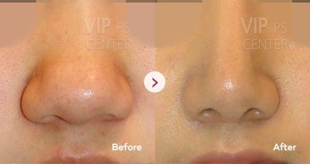 Nose Surgery by Type | VIP Plastic Surgery Korea Bulbous Nose Rhinoplasty, Nose Operation, Natural Nose, Nose Structure, Nose Rhinoplasty, Nose Plastic Surgery, Upturned Nose, Bulbous Nose, Hooked Nose